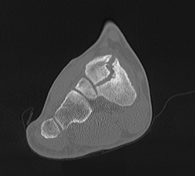 Navicular Fracture CT3